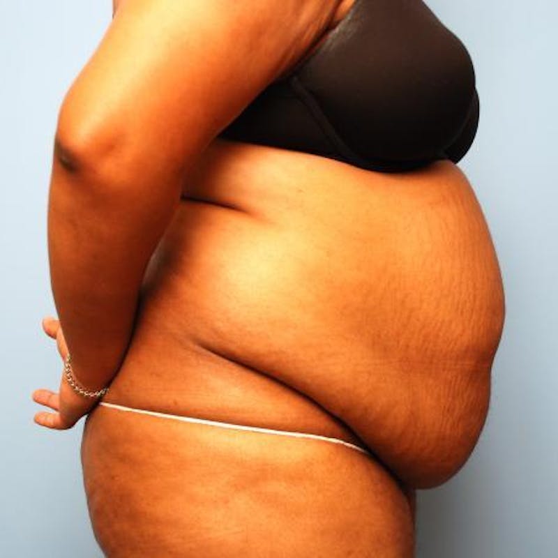 Tummy Tuck Before & After Gallery - Patient 105514 - Image 5