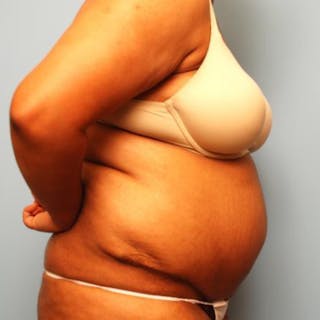 Tummy Tuck Before & After Gallery - Patient 105514 - Image 6