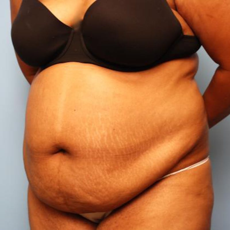 Tummy Tuck Before & After Gallery - Patient 105514 - Image 7