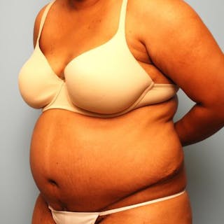 Tummy Tuck Before & After Gallery - Patient 105514 - Image 8