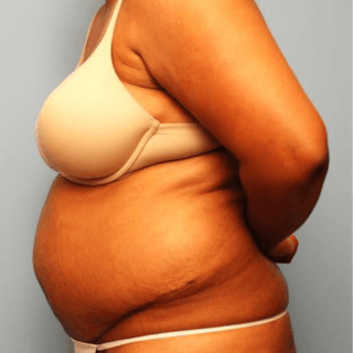 Tummy Tuck Before & After Gallery - Patient 105514 - Image 10