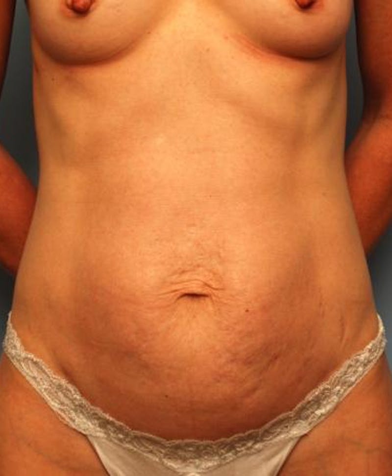 Umbilical Float Tummy Tuck Before & After Gallery - Patient 451173 - Image 1