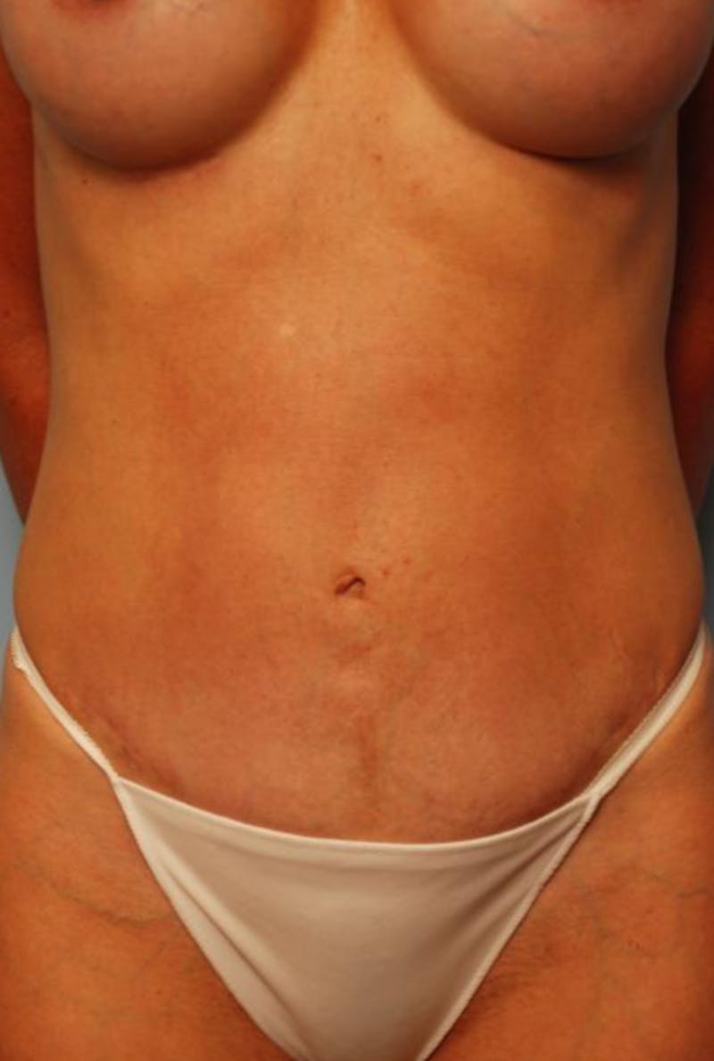 Umbilical Float Tummy Tuck Before & After Gallery - Patient 451173 - Image 2
