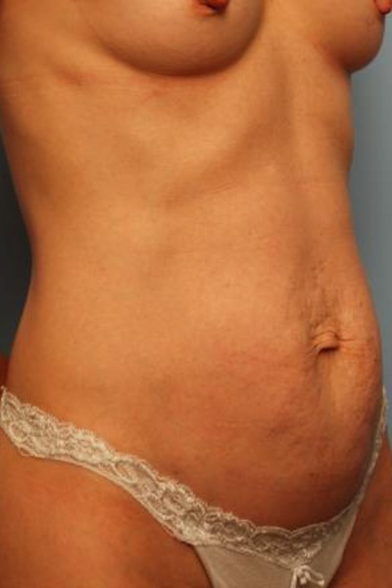 Umbilical Float Tummy Tuck Before & After Gallery - Patient 451173 - Image 3