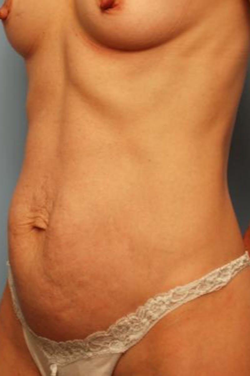 Umbilical Float Tummy Tuck Before & After Gallery - Patient 451173 - Image 7