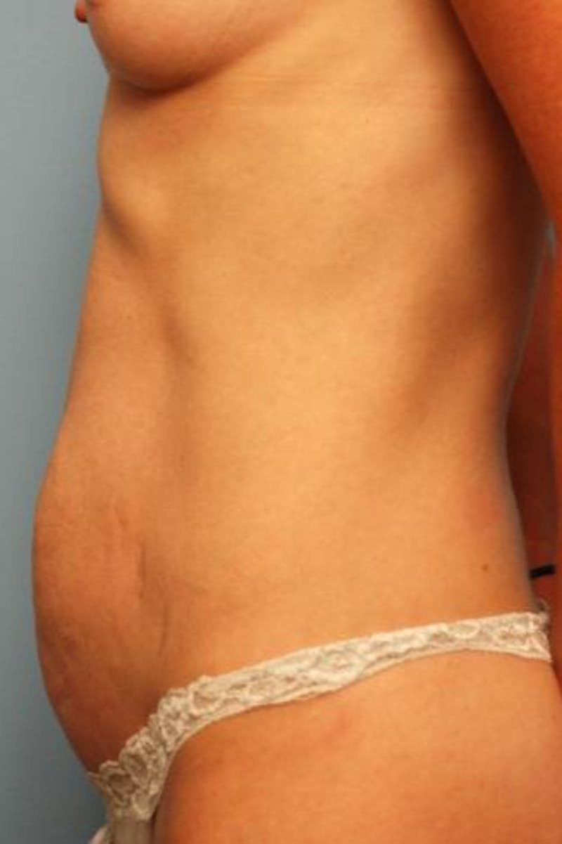 Umbilical Float Tummy Tuck Before & After Gallery - Patient 451173 - Image 9