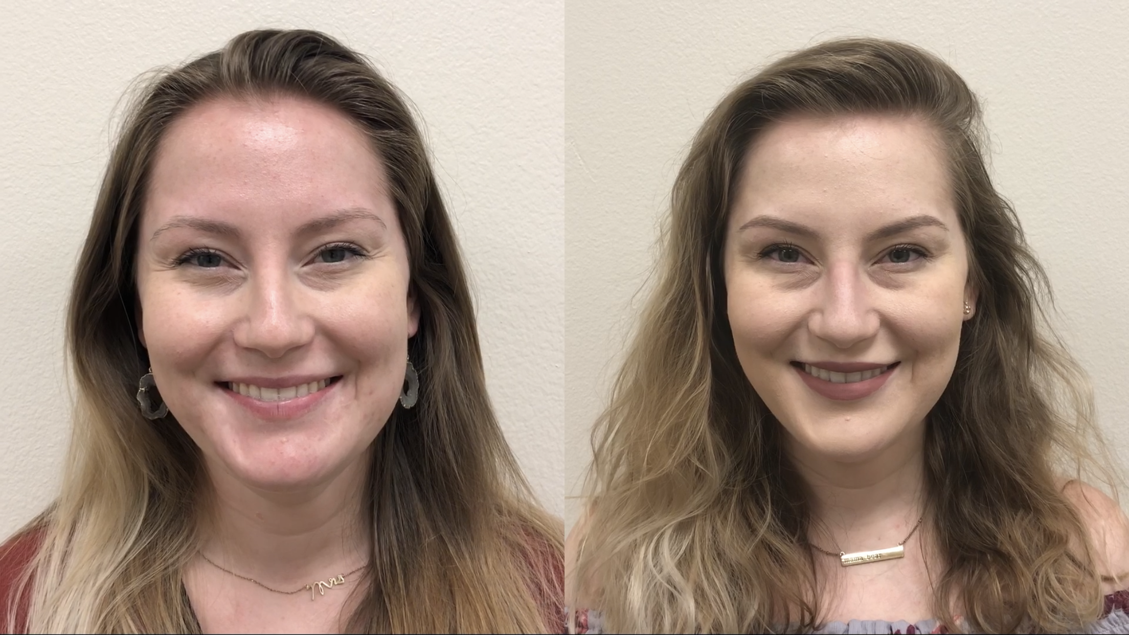 Botox Before & After Gallery - Patient 478747 - Image 3