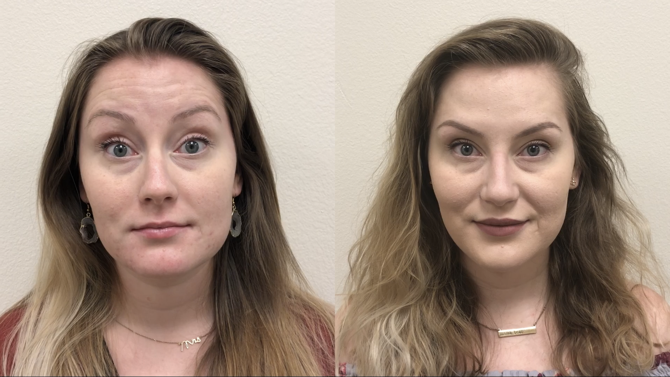 Botox Before & After Gallery - Patient 478747 - Image 2