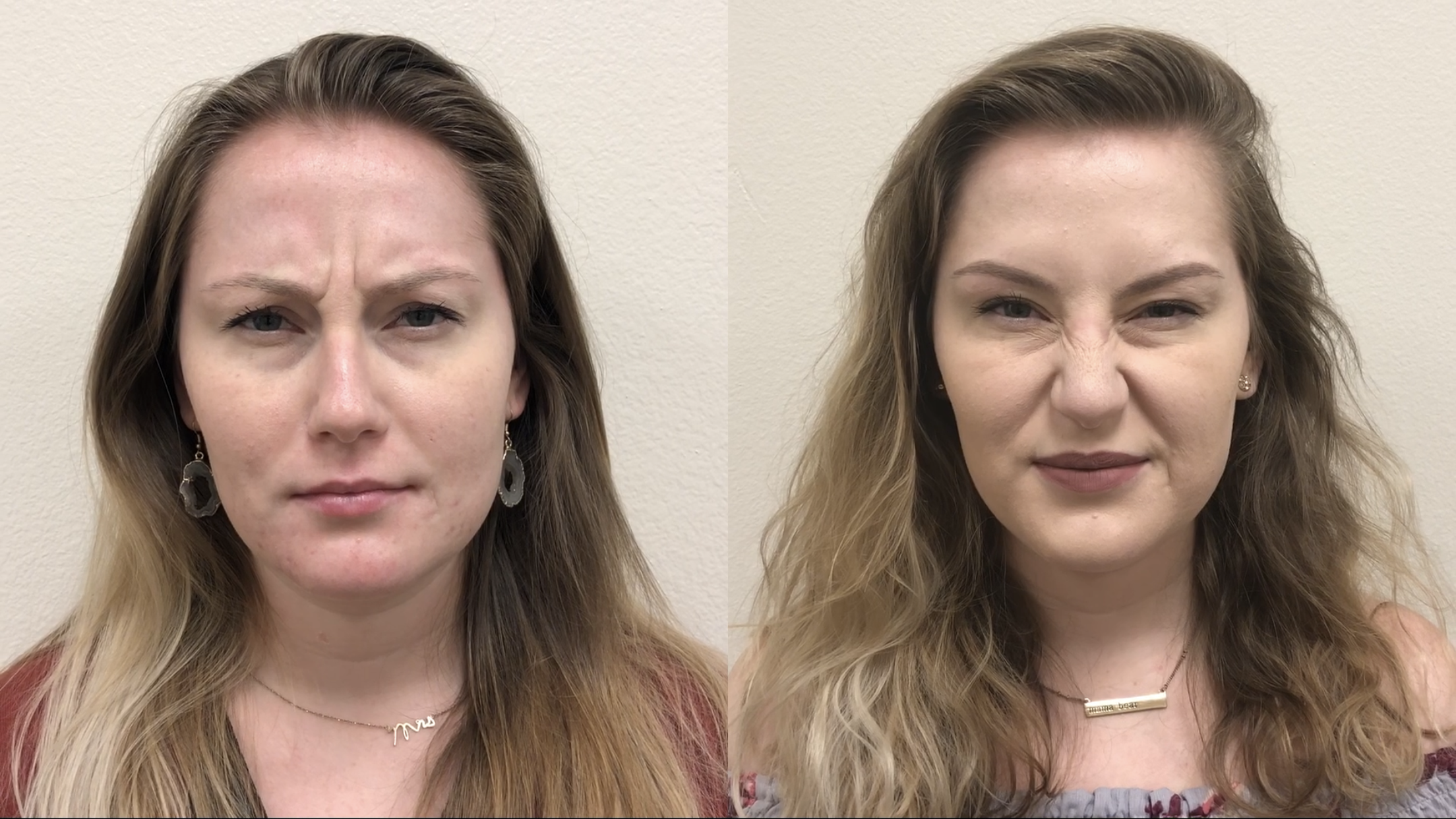 Botox Before & After Gallery - Patient 478747 - Image 1