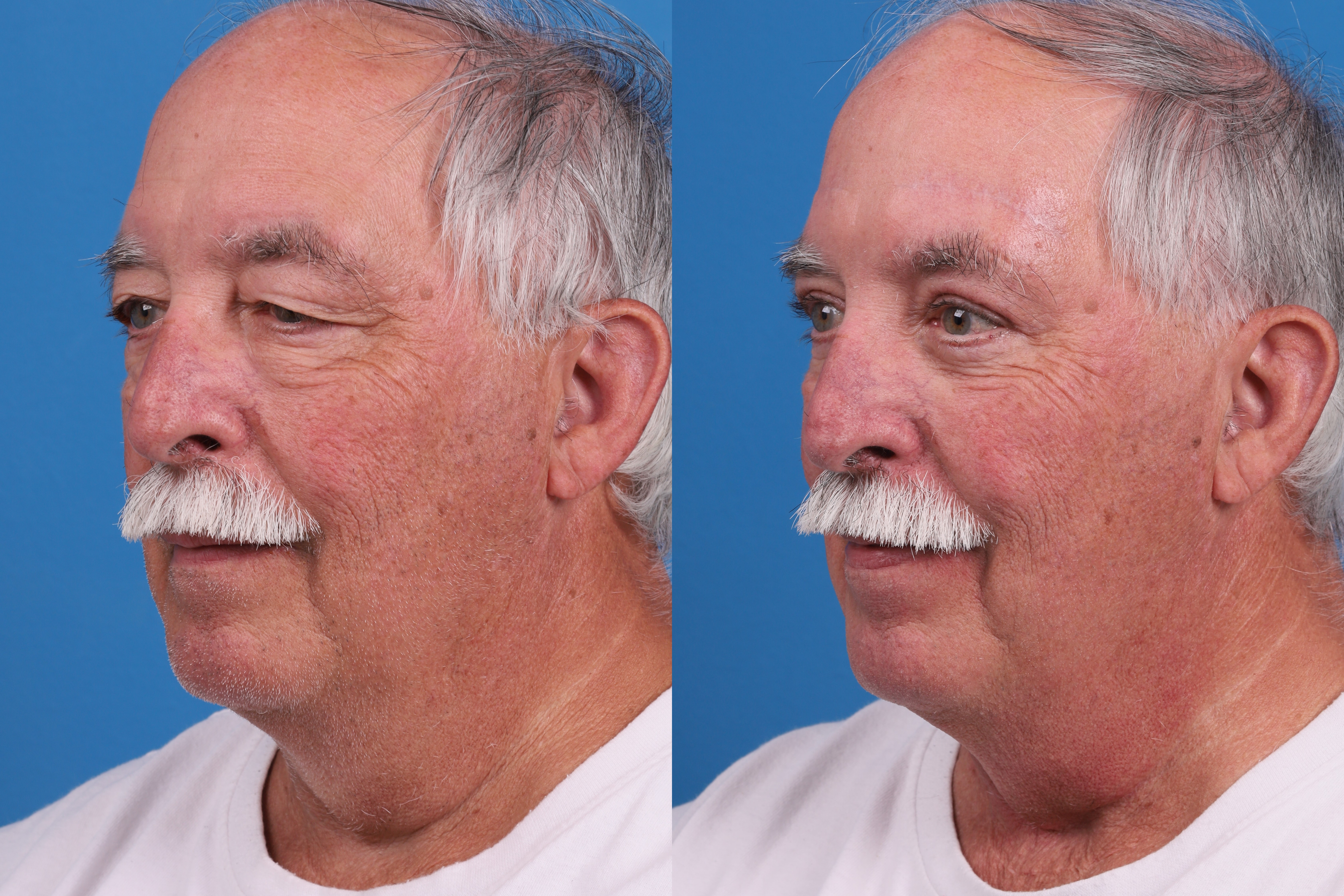 Brow Lift Before & After Gallery - Patient 431758 - Image 3