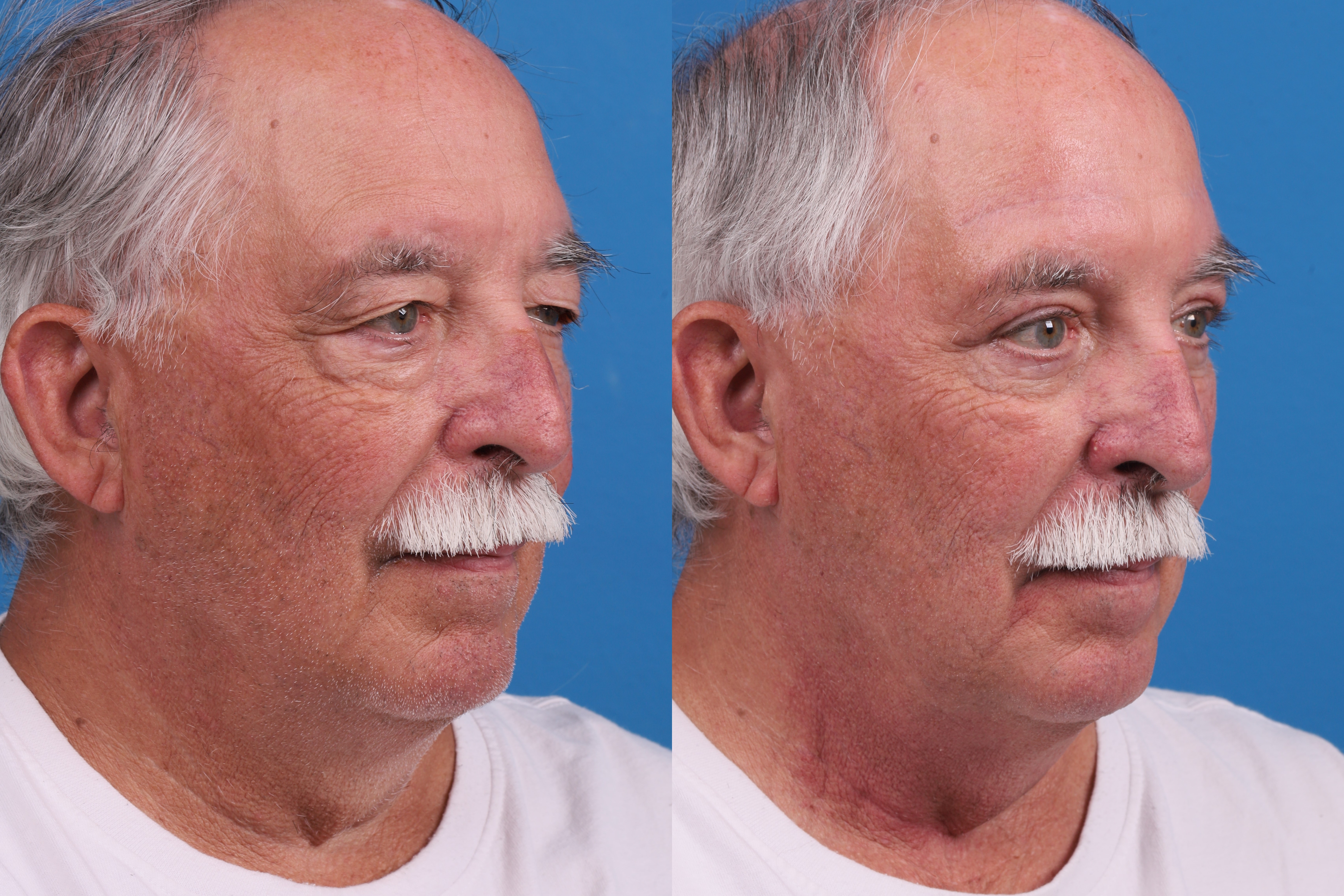 Brow Lift Before & After Gallery - Patient 431758 - Image 2