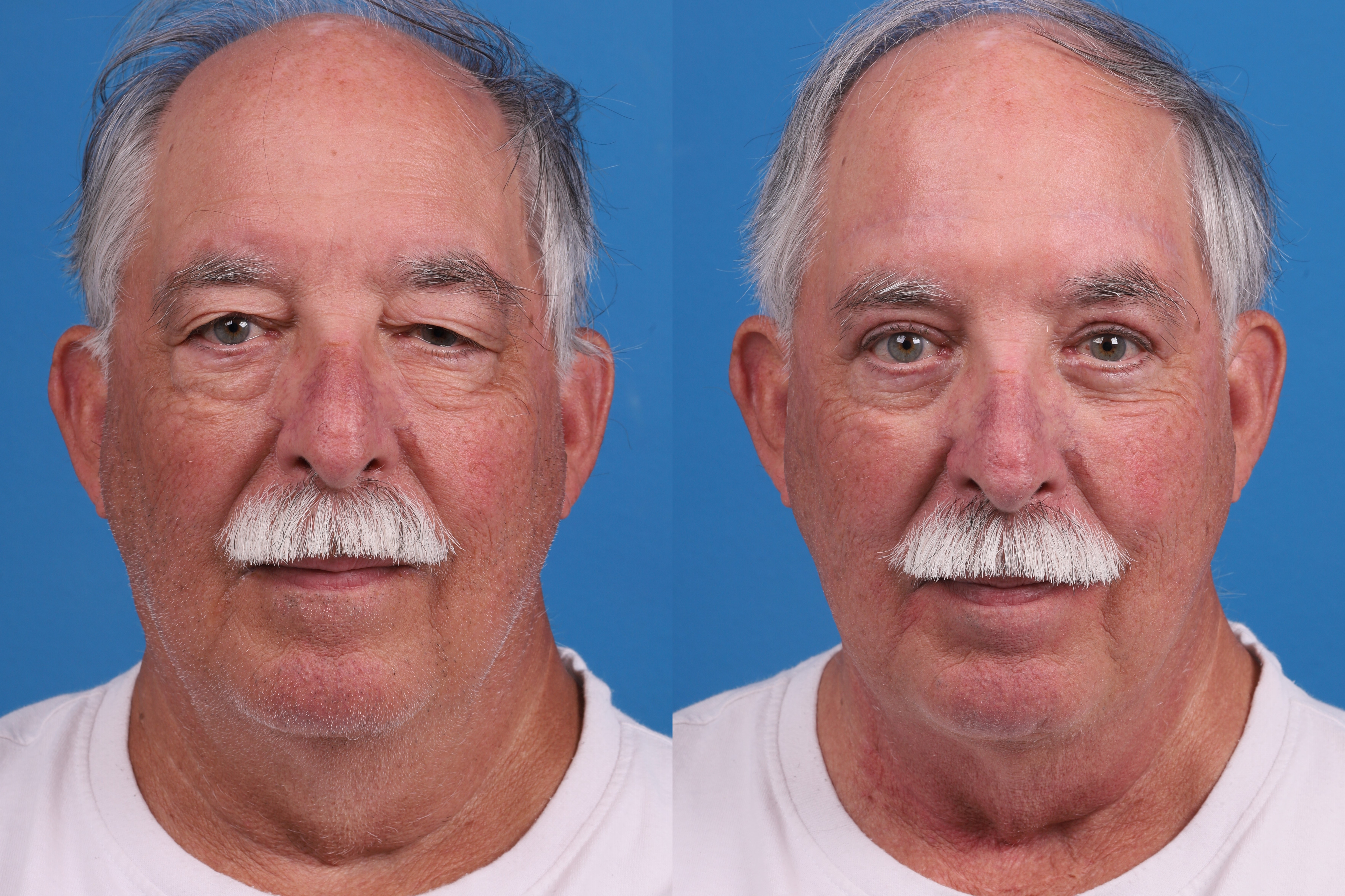 Brow Lift Before & After Gallery - Patient 431758 - Image 1