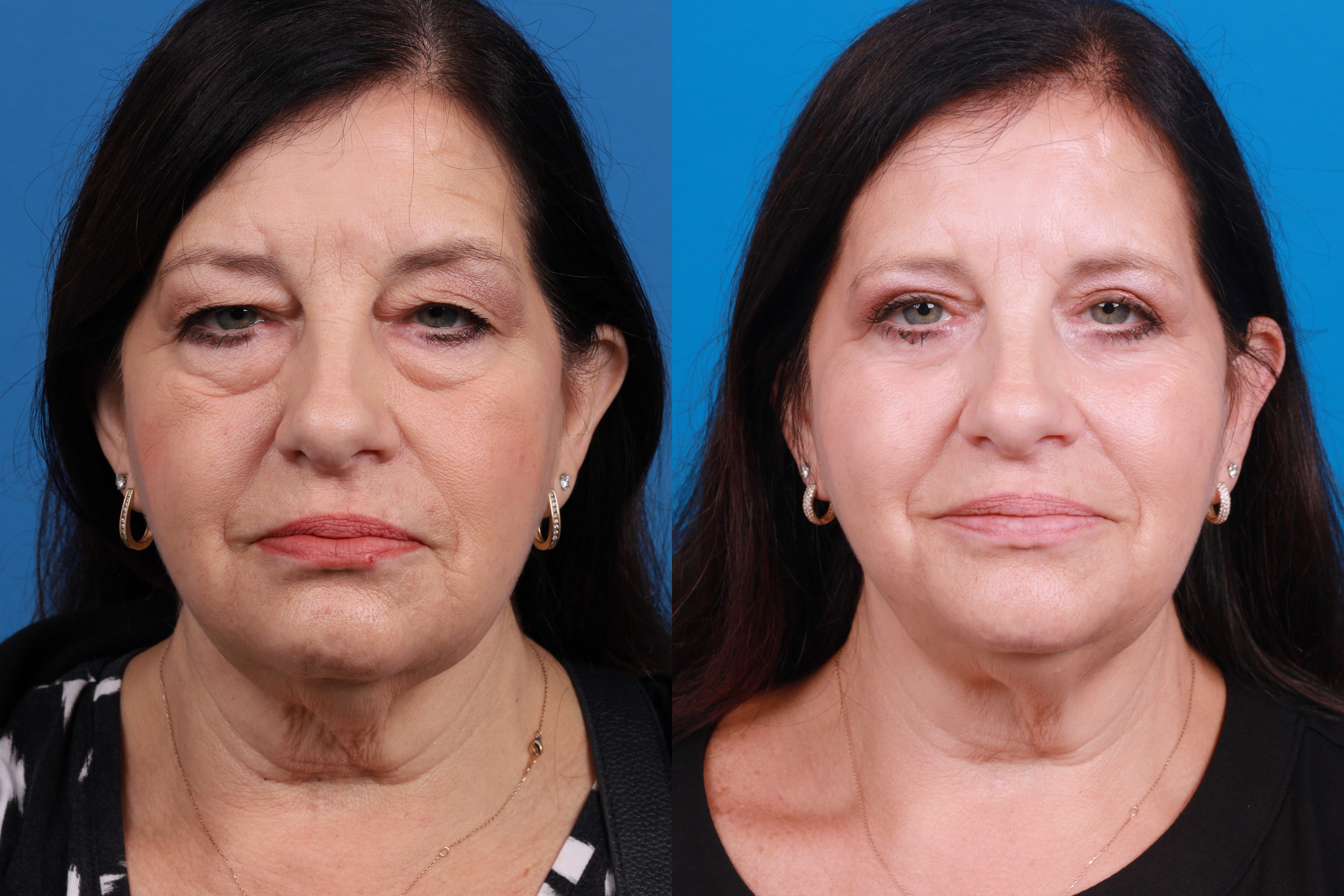 Skin Resurfacing Before & After Gallery - Patient 224873 - Image 1