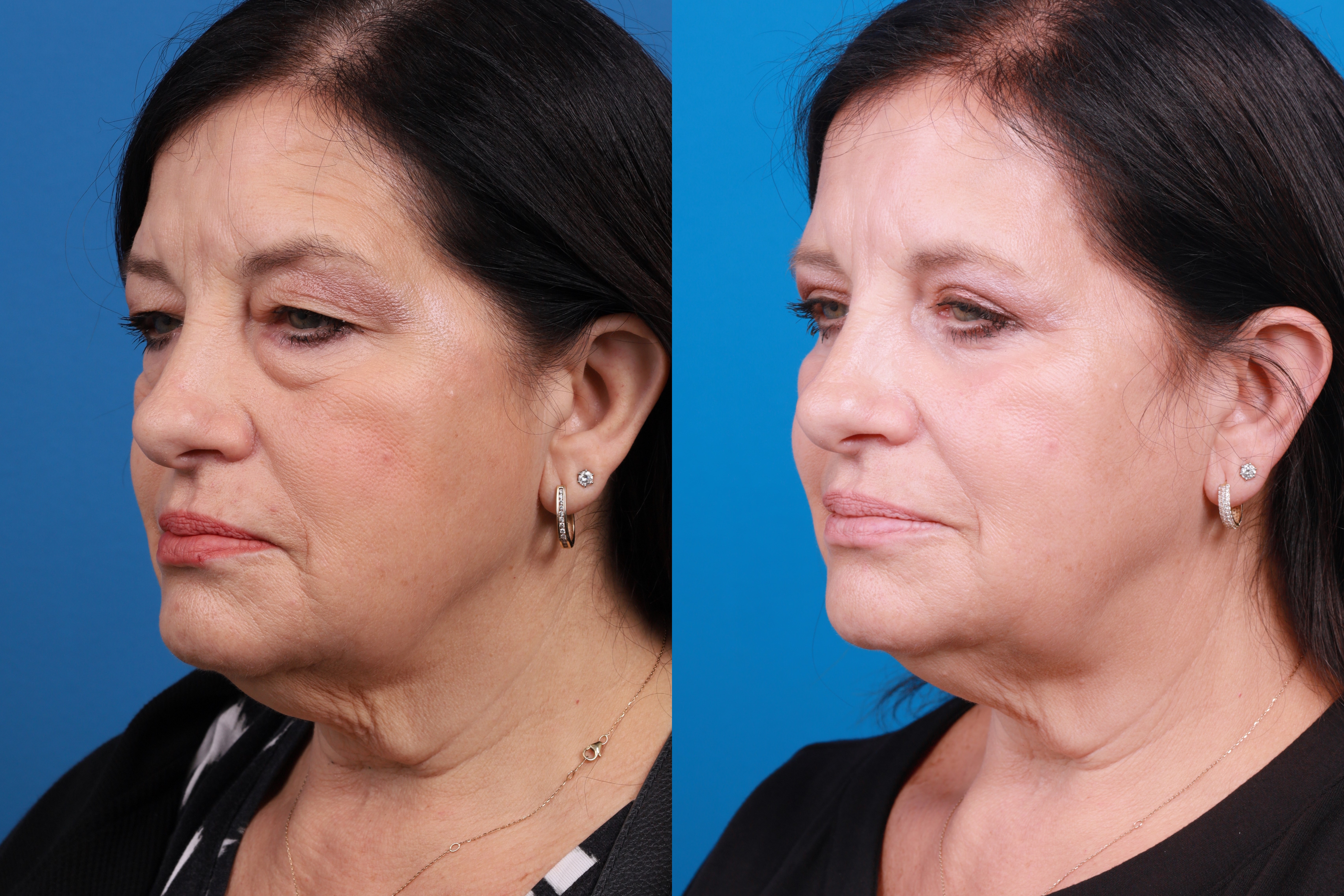 Skin Resurfacing Before & After Gallery - Patient 224873 - Image 2
