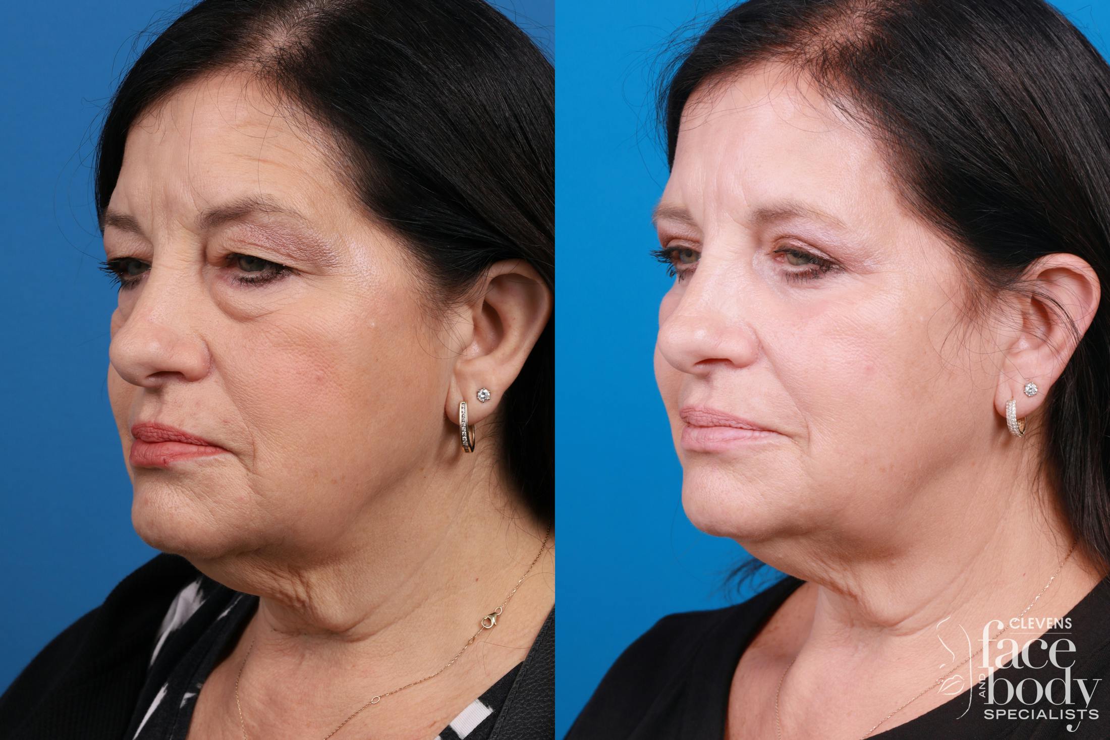Skin Resurfacing Before & After Gallery - Patient 224873 - Image 2