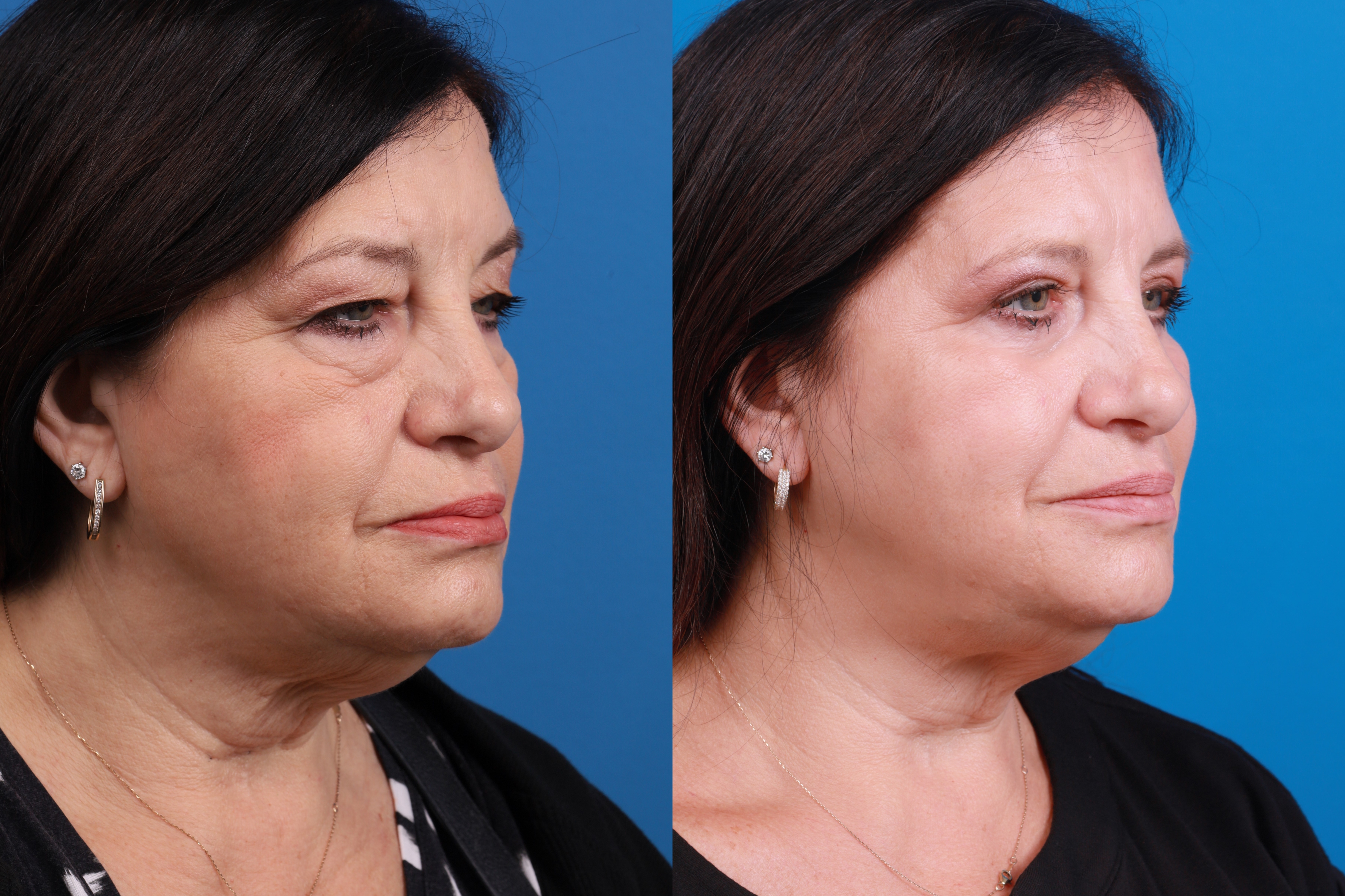 Skin Resurfacing Before & After Gallery - Patient 224873 - Image 3