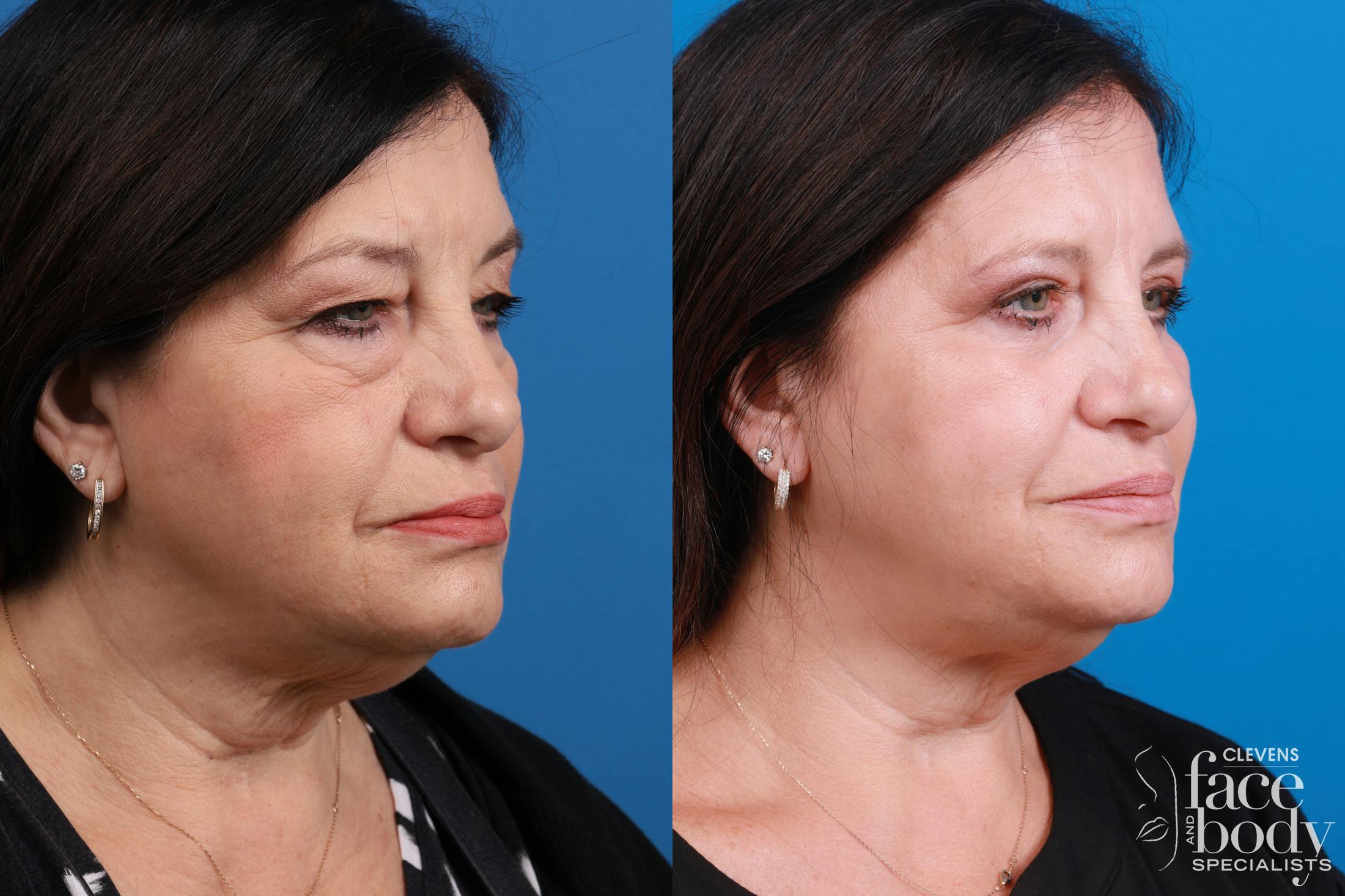 Skin Resurfacing Before & After Gallery - Patient 224873 - Image 3
