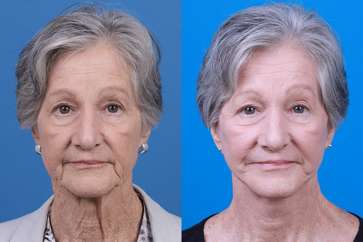 Facelift Before & After Gallery - Patient 421736 - Image 1