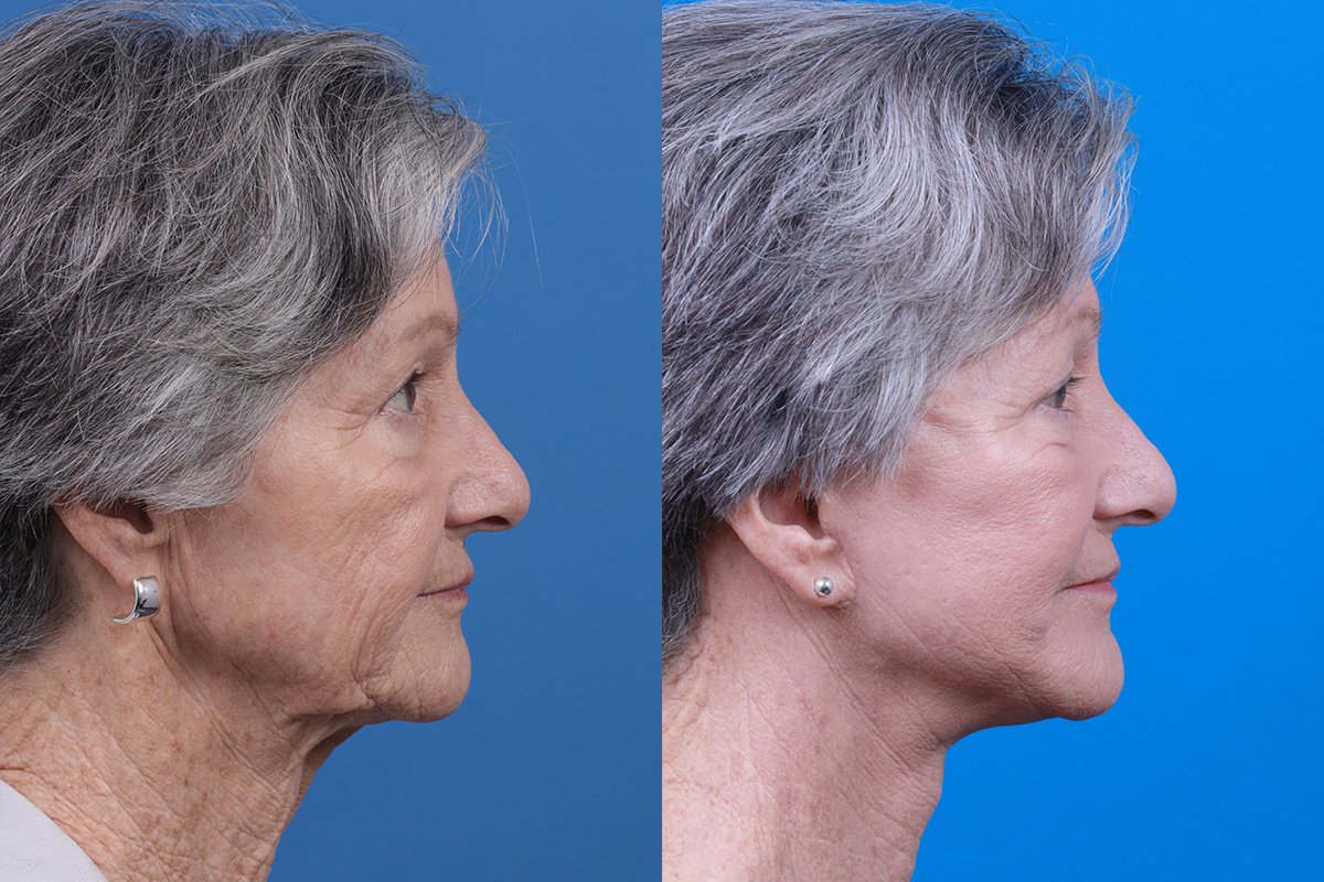 Facelift Before & After Gallery - Patient 421736 - Image 3
