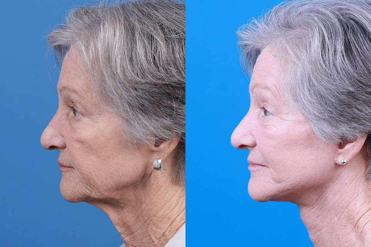 Facelift Before & After Gallery - Patient 421736 - Image 5