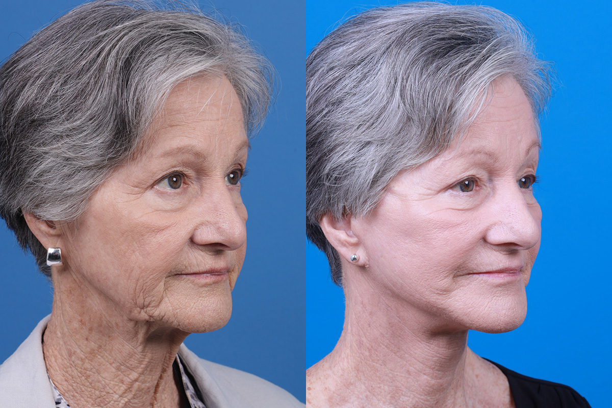 Facelift Before & After Gallery - Patient 421736 - Image 2