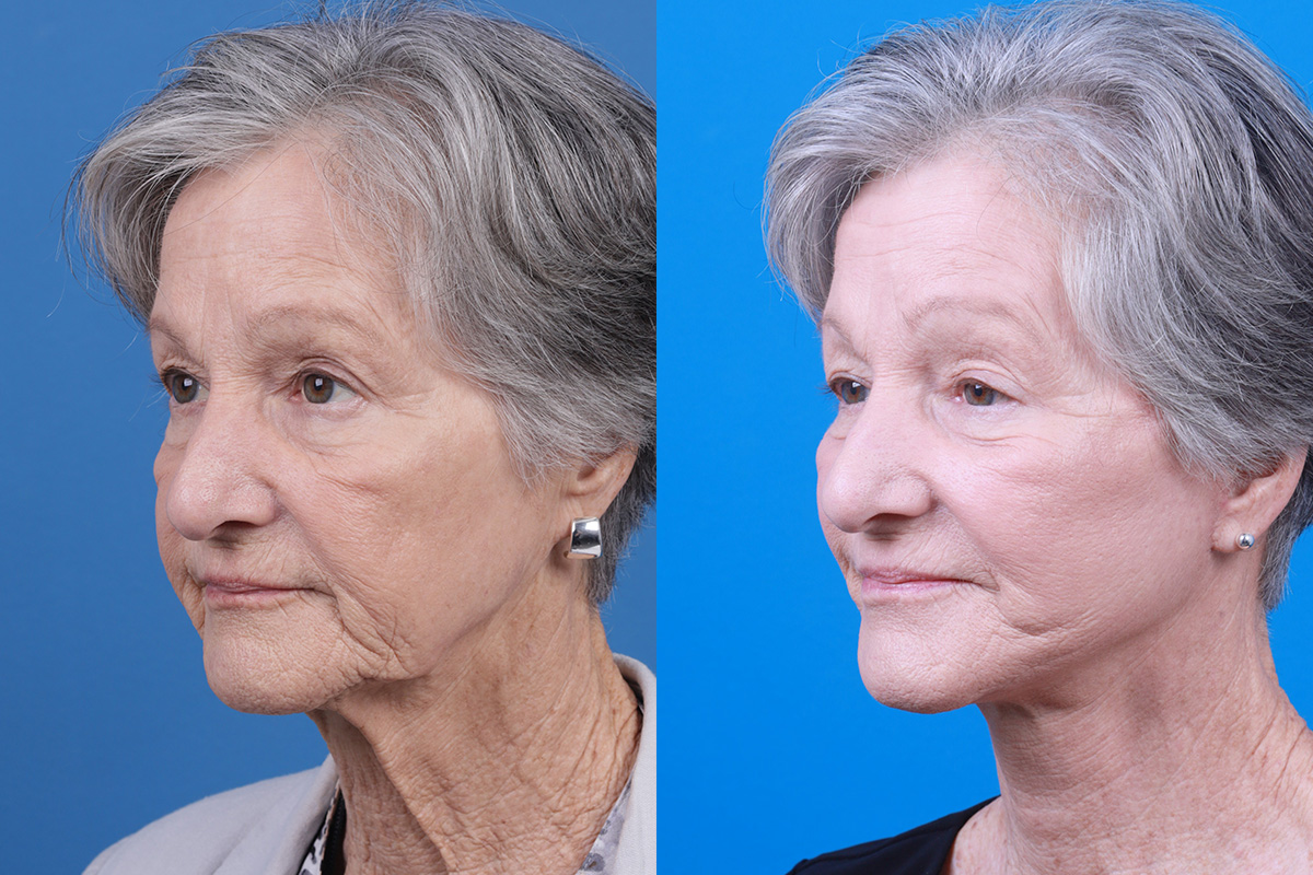 Facelift Before & After Gallery - Patient 421736 - Image 4