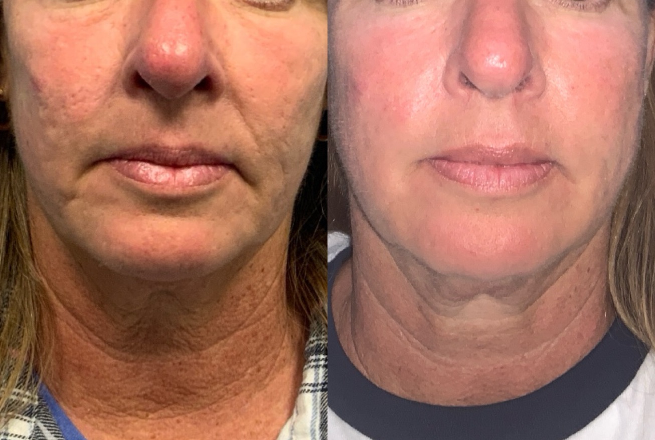 Dermal Fillers Before & After Gallery - Patient 728108 - Image 1