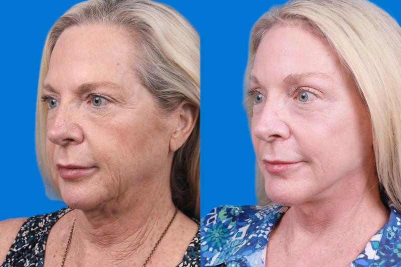 Brow Lift Before & After Gallery - Patient 148447977 - Image 4