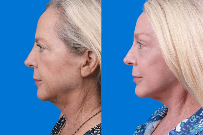 Brow Lift Before & After Gallery - Patient 148447977 - Image 5