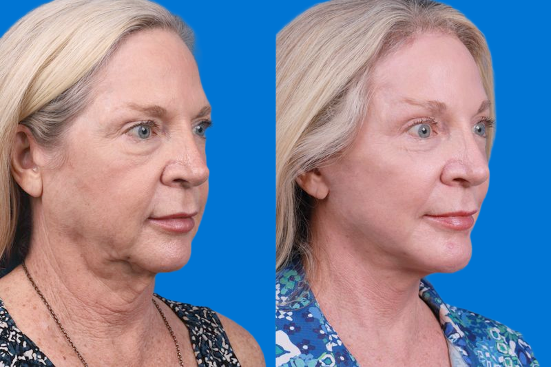 Brow Lift Before & After Gallery - Patient 148447977 - Image 2