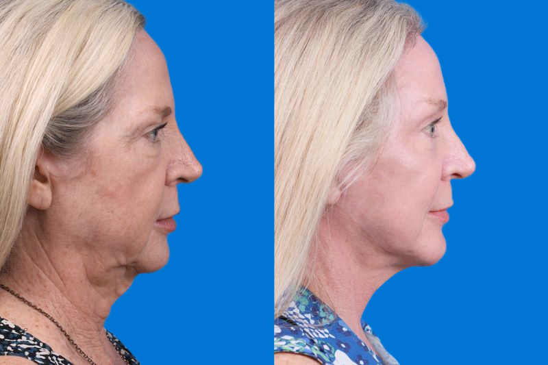 Brow Lift Before & After Gallery - Patient 148447977 - Image 3