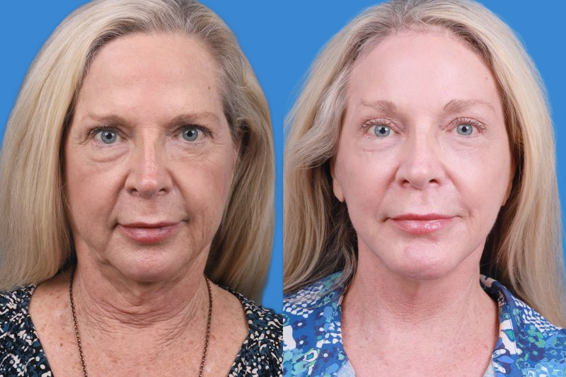 Brow Lift Before & After Gallery - Patient 148447977 - Image 1
