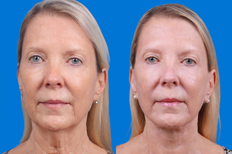 Facelift Before & After Gallery - Patient 163001391 - Image 1