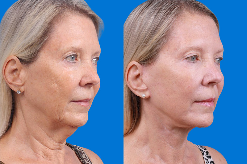 Facelift Before & After Gallery - Patient 163001391 - Image 2