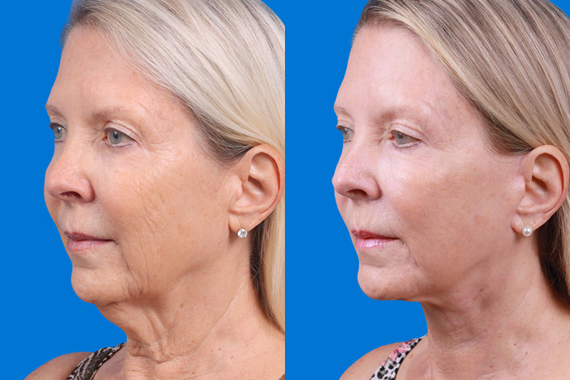 Facelift Before & After Gallery - Patient 163001391 - Image 4