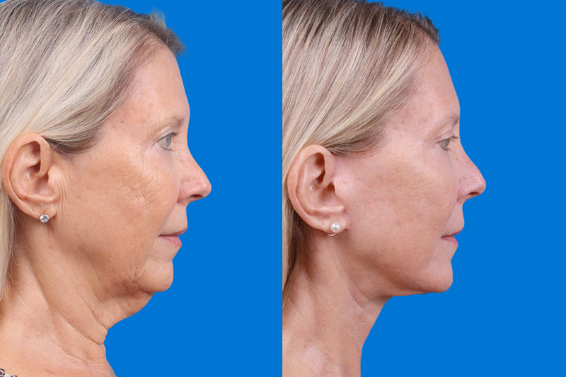 Facelift Before & After Gallery - Patient 163001391 - Image 3