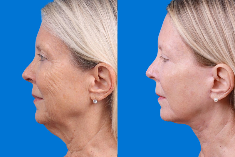 Facelift Before & After Gallery - Patient 163001391 - Image 5