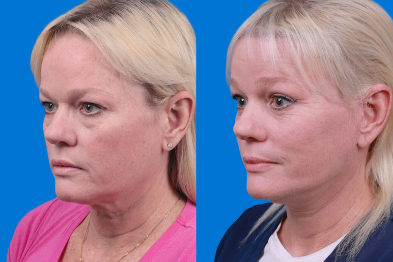 Facelift Before & After Gallery - Patient 148679036 - Image 4
