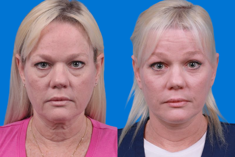 Eyelid Surgery Before & After Gallery - Patient 150527 - Image 1