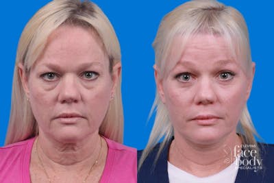 Eyelid Surgery Before & After Gallery - Patient 150527 - Image 1