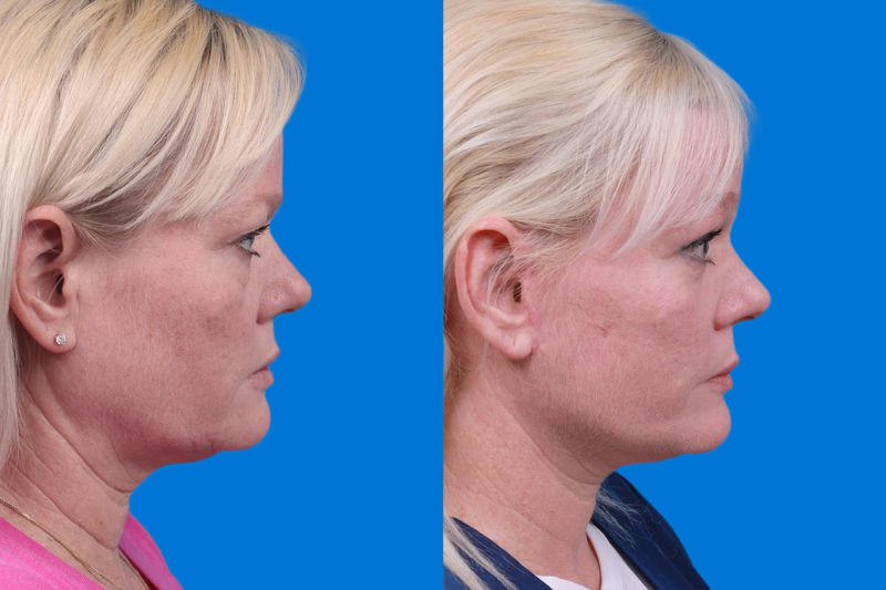 Facelift Before & After Gallery - Patient 148679036 - Image 3