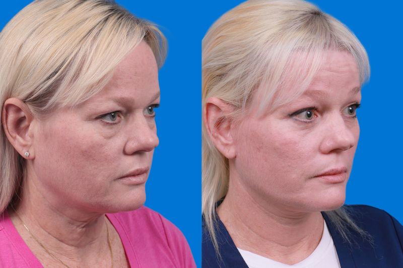 Facelift Before & After Gallery - Patient 148679036 - Image 2