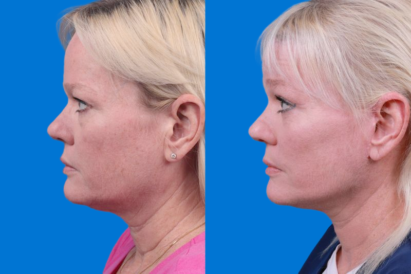 Facelift Before & After Gallery - Patient 148679036 - Image 5