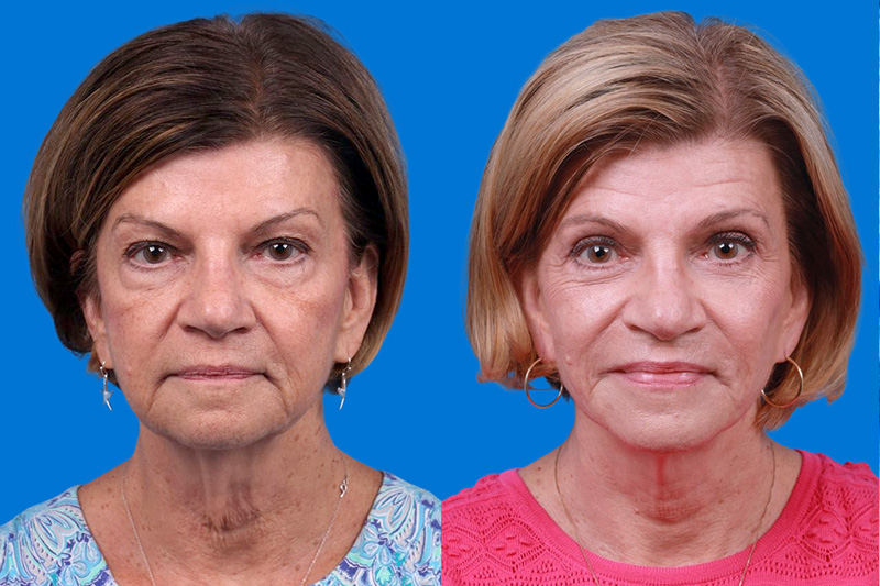 Eyelid Surgery Before & After Gallery - Patient 368082 - Image 1