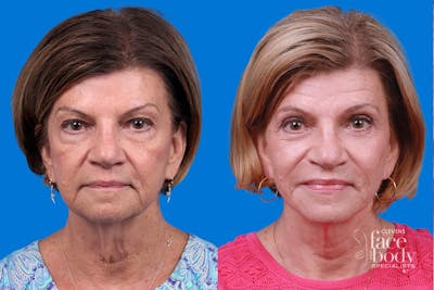 Eyelid Surgery Before & After Gallery - Patient 319477 - Image 1
