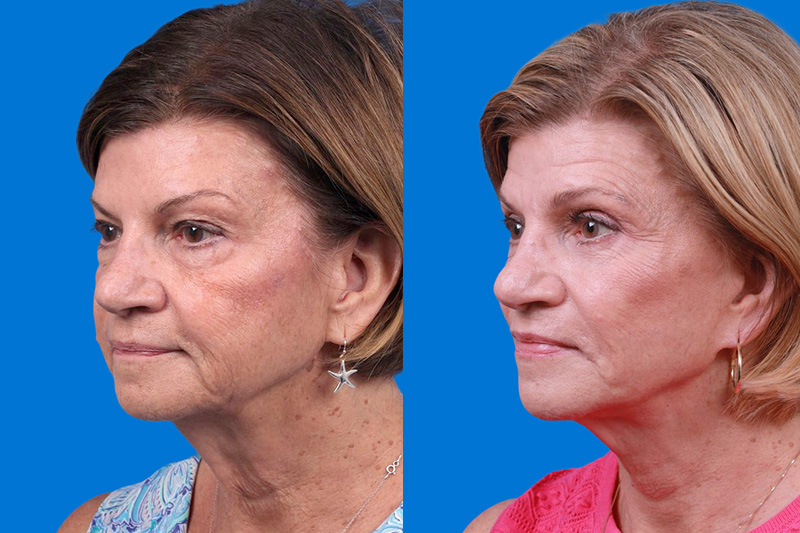 Facelift Before & After Gallery - Patient 416507 - Image 4