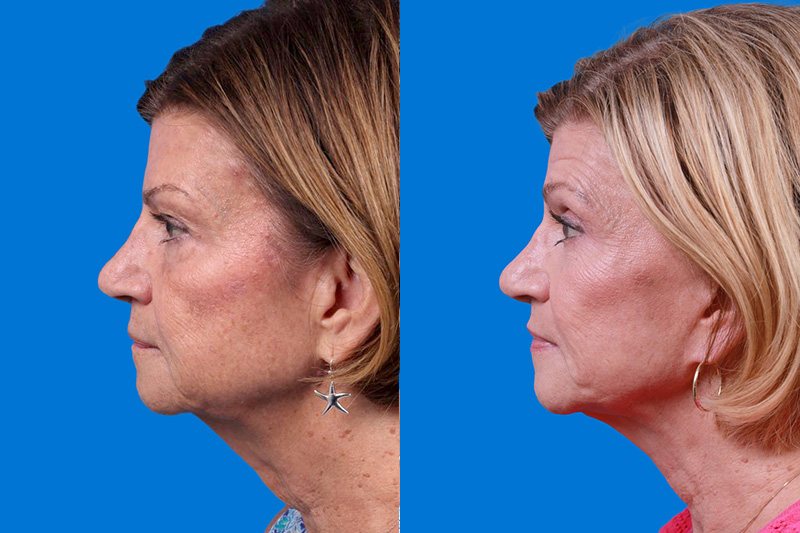 Facelift Before & After Gallery - Patient 416507 - Image 5