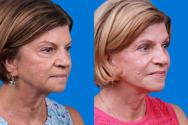 Facelift Before & After Gallery - Patient 416507 - Image 2