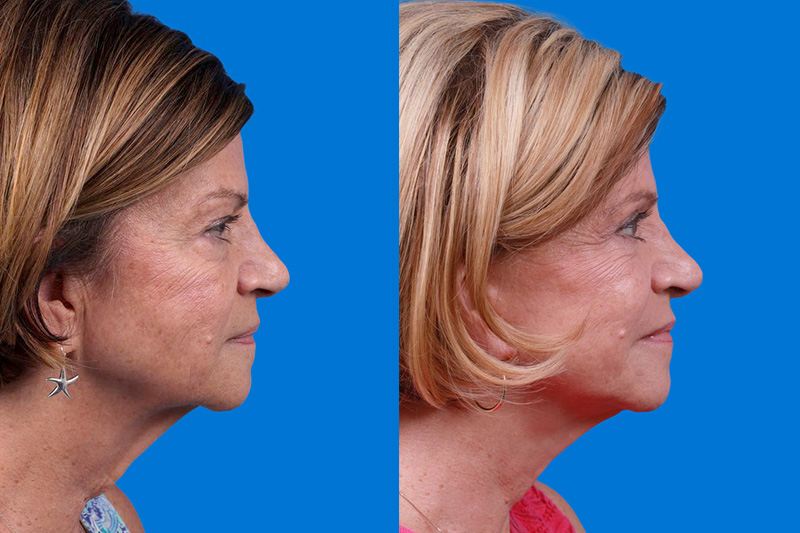 Facelift Before & After Gallery - Patient 416507 - Image 3