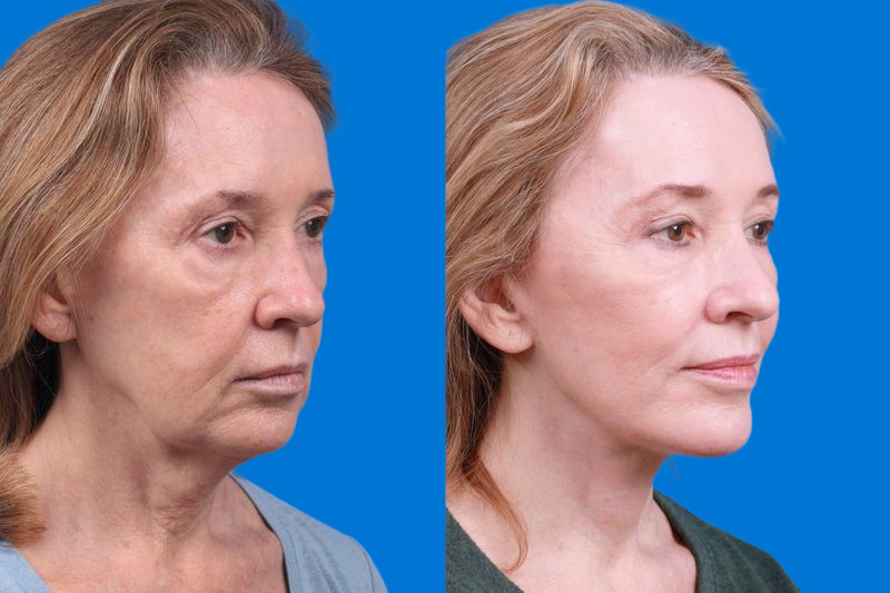 Facelift Before & After Gallery - Patient 146528293 - Image 2